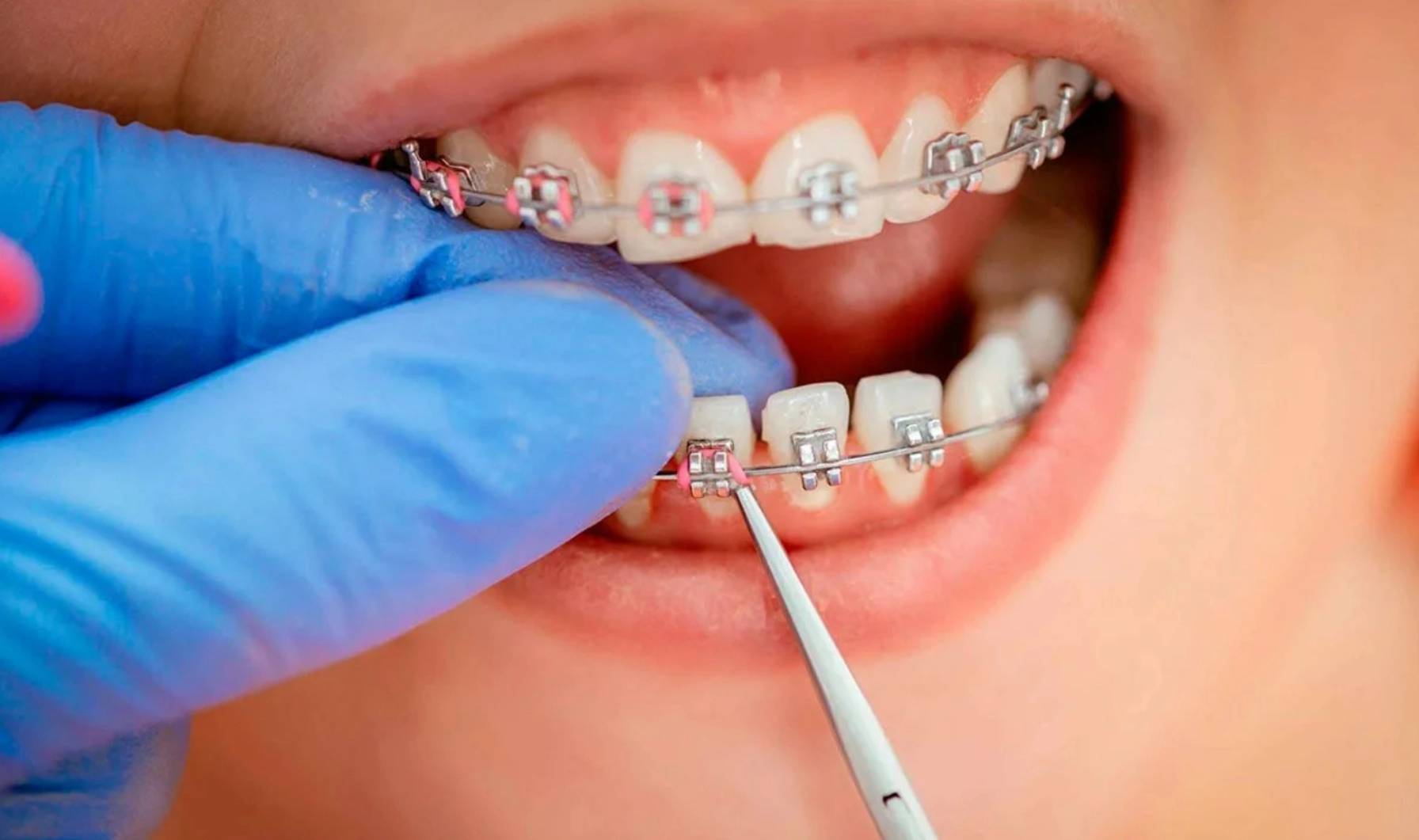 Braces System